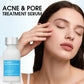 Clear Acne & Shrink Pores Fast! 💧 Acne Control Serum – Oil-Free, Visible Results in Weeks